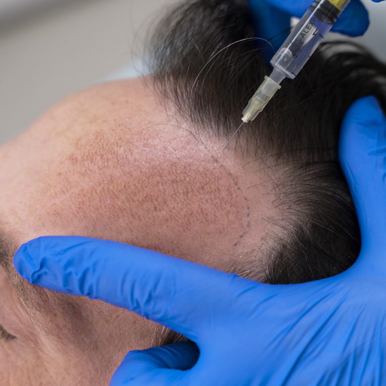 hombre-recibiendo-un-tratamiento-para-la-caida-del-cabello (1)